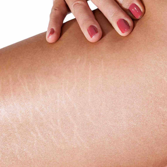 6 Home remedies for stretch marks